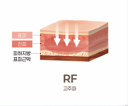 RF 시술 시각화