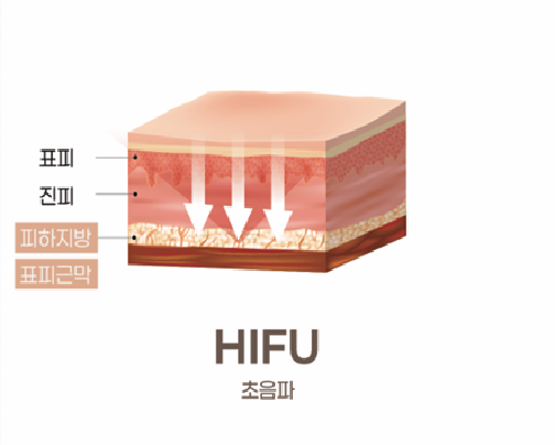 HIFU SMAS층 시각화